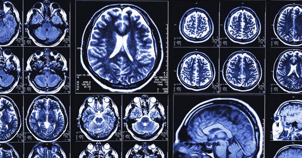 Des scientifiques créent un outil d'IA qui permet de prédire la maladie d'Alzheimer avec une précision allant jusqu'à 82 %