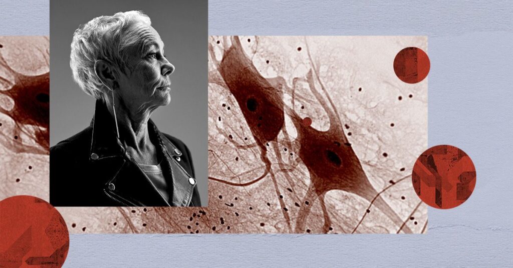 La gestion du cholestérol peut aider à réduire le risque de maladie d'Alzheimer et de Parkinson