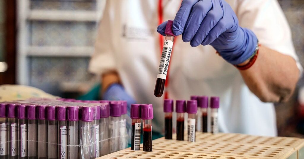 Un test sanguin montre une précision de 90 % dans l'identification de la maladie d'Alzheimer
