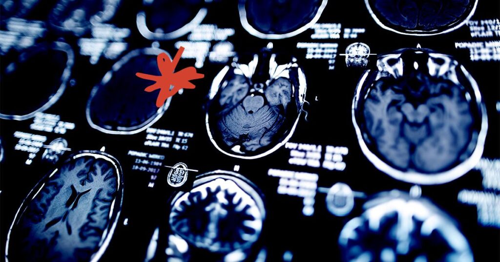 Les médicaments GLP-1 comme Ozempic peuvent protéger la santé cérébrale, selon plusieurs études