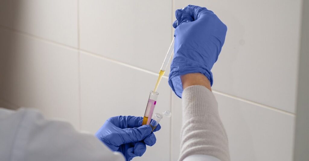 Le test de cholestérol sanguin simple peut mieux prédire le risque de maladie de l'artère coronaire