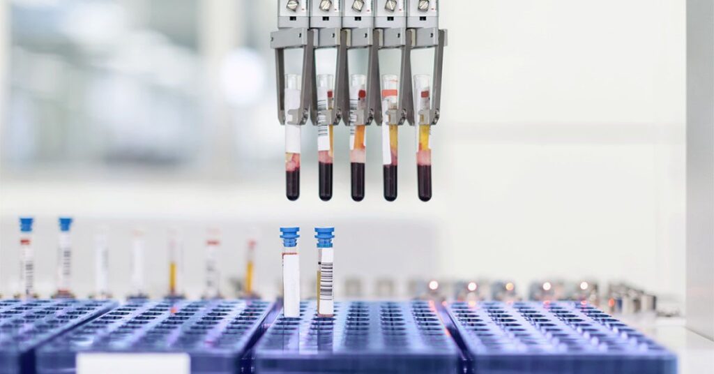 Le test de résistance à l'insuline peut aider à prédire le taux de déclin cognitif d'Alzheimer