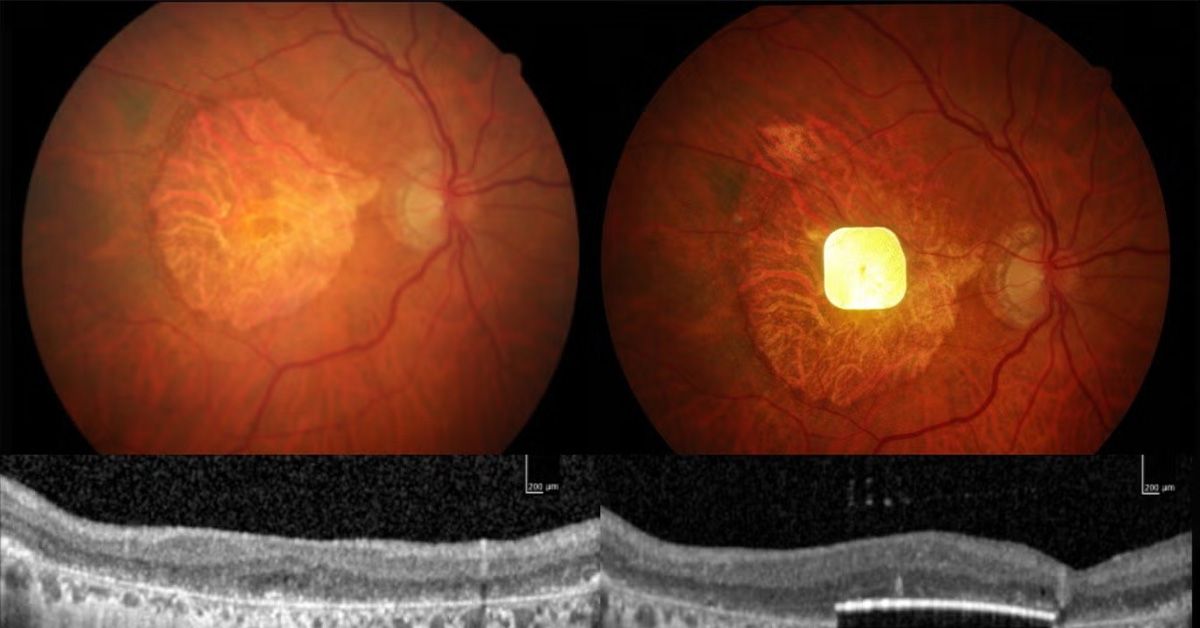 Un nouvel implant rétinien pourrait restaurer la vision centrale chez les personnes atteintes de DMLA avancée