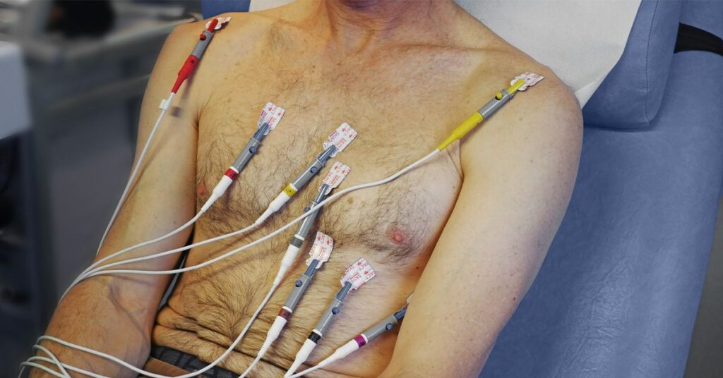 Des niveaux élevés de biomarqueurs de lésions cardiaques peuvent signaler un risque accru de démence