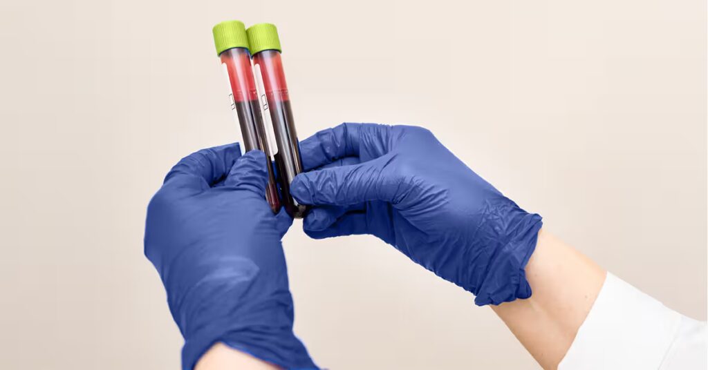 Un test sanguin pour la maladie d'Alzheimer entre 53 et 69 ans pourrait aider à détecter un déclin cognitif précoce