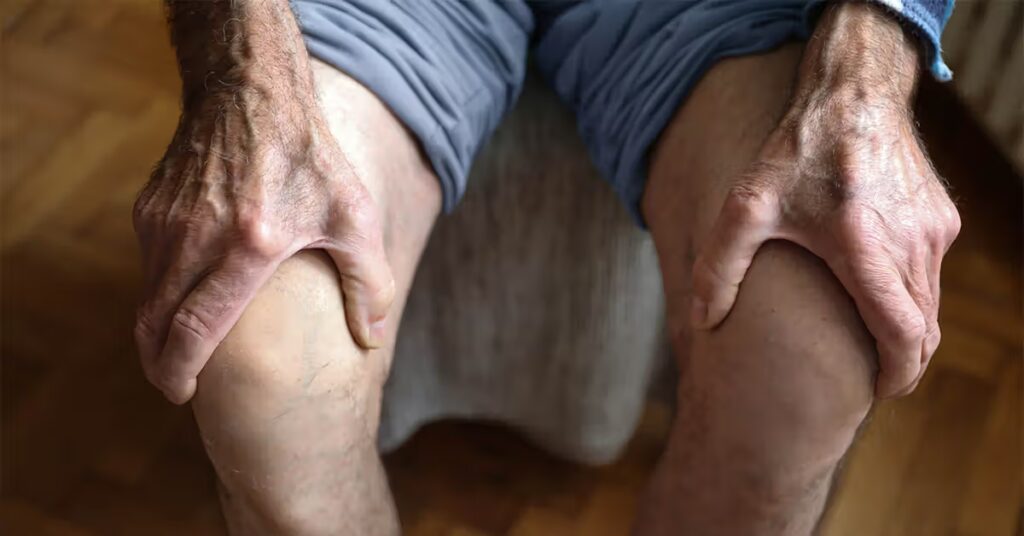 La chirurgie pourrait aggraver l’arthrose du genou, selon une étude, alors qu’est-ce qui pourrait aider ?