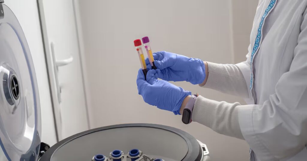 Un nouveau test sanguin basé sur l’ARN semble prometteur pour une détection plus précoce de la maladie d’Alzheimer