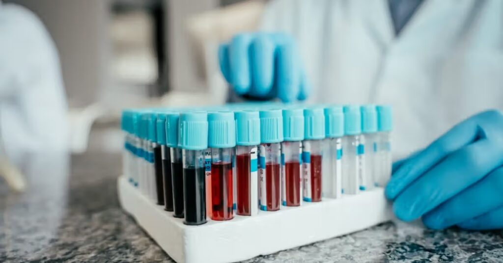 Le test sanguin de la maladie d'Alzheimer pourrait identifier le risque jusqu'à 10 ans avant l'apparition des symptômes