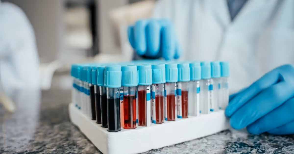 Le test sanguin de la maladie d'Alzheimer pourrait identifier le risque jusqu'à 10 ans avant l'apparition des symptômes