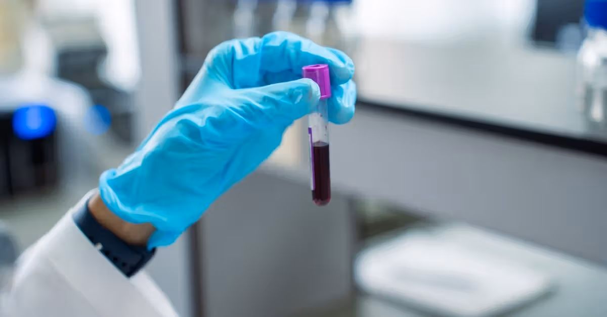 Un test sanguin de biomarqueur amélioré par l'IA pourrait détecter le cancer du pancréas plus tôt, suggère une étude