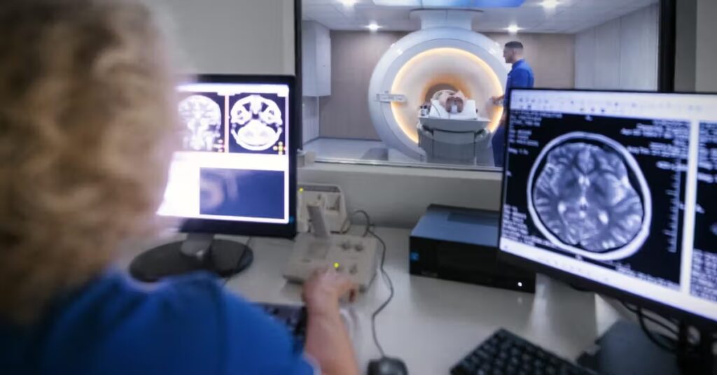 L’IA complète les radiologues pour aider à améliorer la détection des anévrismes cérébraux