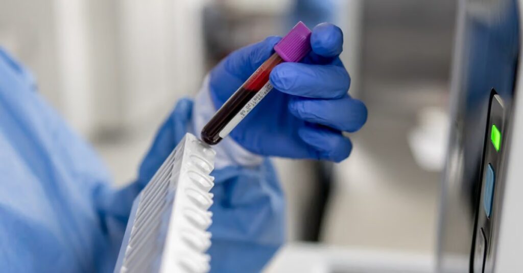 Le risque de cancer de la prostate peut être détectable dans le sang 15 ans avant le diagnostic